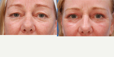 Eyelid Surgery before and after photo