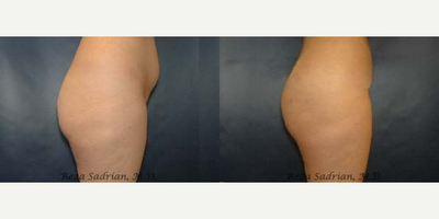 Brazilian Butt Lift before and after photo
