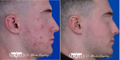 Laser Scar Removal before and after photo