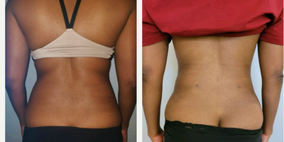 Smart Lipo before and after photo