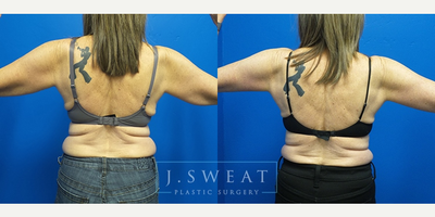 Arm Lift before and after photo