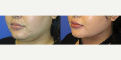 Buccal Fat Removal before and after photo