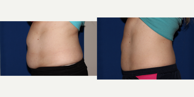CoolSculpting before and after photo