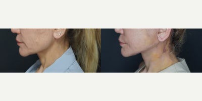 Deep Plane Facelift before and after photo