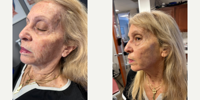 Dermal Fillers before and after photo