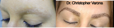 Eyebrow Transplant before and after photo