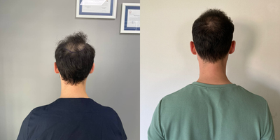FUE Hair Transplant before and after photo