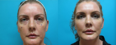 Nonsurgical Facelift before and after photo