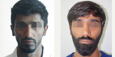 Beard Transplant before and after photo