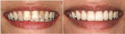 Dental Crown before and after photo