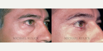Eyelid Surgery before and after photo