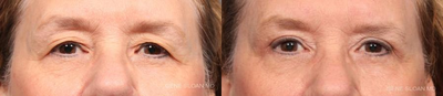 Eyelid Surgery before and after photo