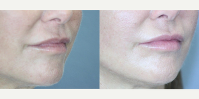 Infini RF before and after photo