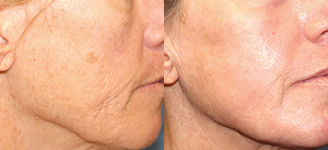Laser Resurfacing before and after photo
