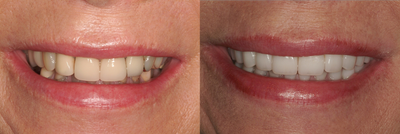 Dental Implants before and after photo