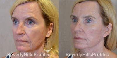 Facelift before and after photo