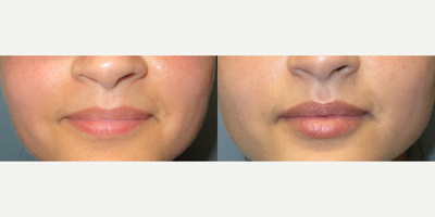 Lip Fillers before and after photo