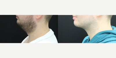 Liposuction before and after photo