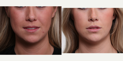 Restylane Defyne before and after photo