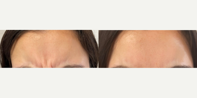 Botox before and after photo