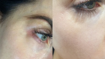 Dermal Fillers before and after photo