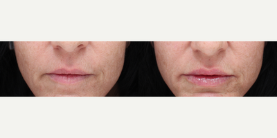 Dermal Fillers before and after photo