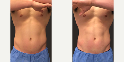 Emsculpt before and after photo
