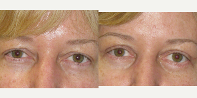 Eyelid Surgery before and after photo