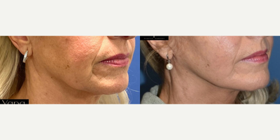 Facelift before and after photo