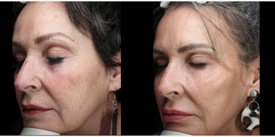 Laser Resurfacing before and after photo