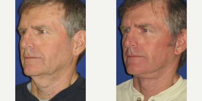 Lower Facelift before and after photo