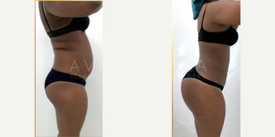 Brazilian Butt Lift before and after photo