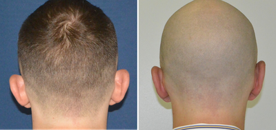 Ear Surgery before and after photo