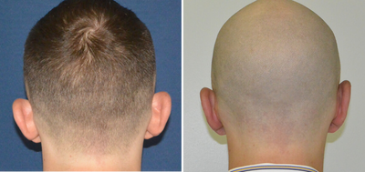Ear Surgery before and after photo