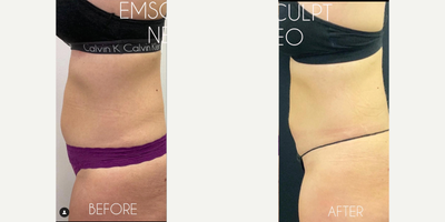 Emsculpt before and after photo