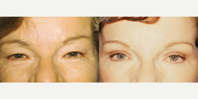Eyelid Surgery before and after photo