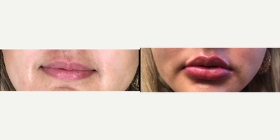 Juvederm before and after photo