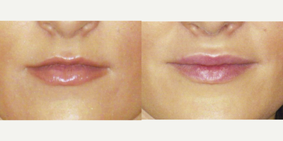 Lip Fillers before and after photo