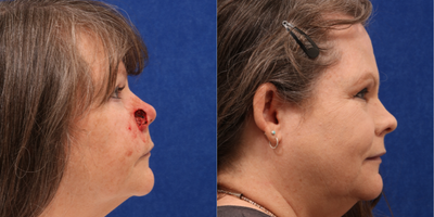 Mohs Surgery before and after photo