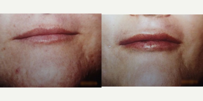 Transgender Facial Feminization Surgery before and after photo