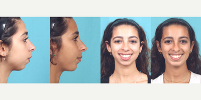 Chin Implant before and after photo