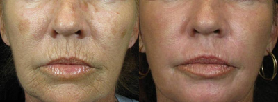 CO2 Laser before and after photo