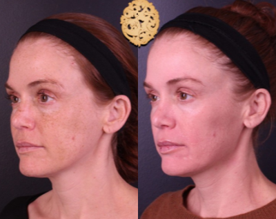 Cosmelan before and after photo