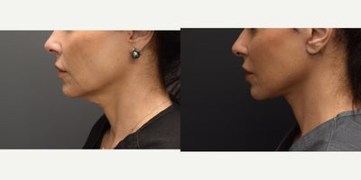 Deep Plane Facelift before and after photo