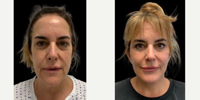 Eyelid Surgery before and after photo