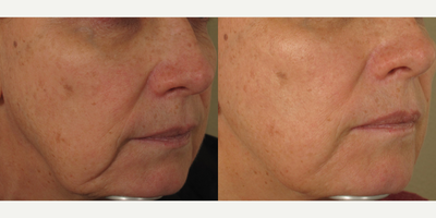 Nonsurgical Facelift before and after photo