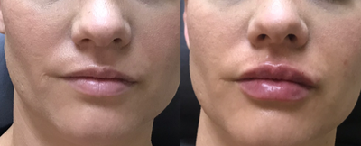 Dermal Fillers before and after photo