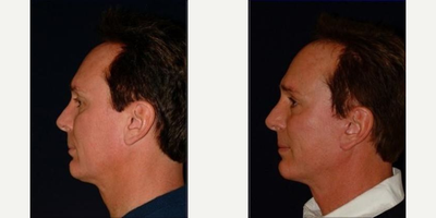 Facelift before and after photo
