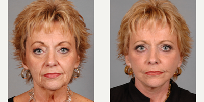 Facelift before and after photo