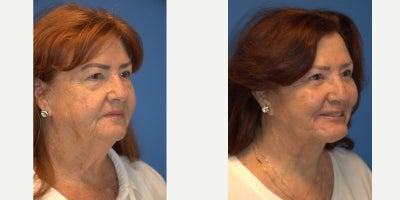 Facelift before and after photo